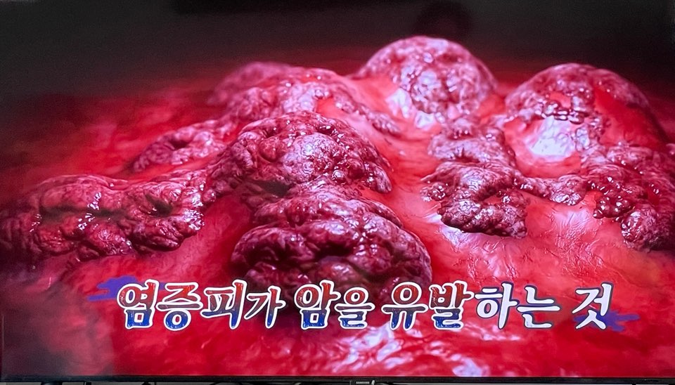 염증피가 암을 유발한다