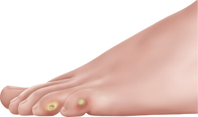 티눈 증상 제거 자가치료법