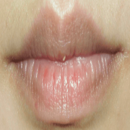 레이저 입술문신을 통해 검은색 색소가 없어진 모습