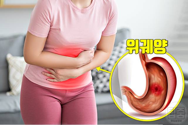 위염 증상 위염원인 위궤양