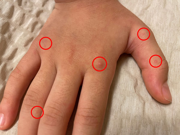 수족구 증상 - 손 부위 발진