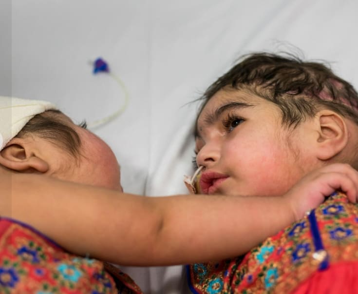 머리 붙은 세 살배기 쌍동이 수술 성공적 분리...전세계 의사들, '가상현실'에서 함께 참여 VIDEO: Conjoined twins separated with the help of virtual reality