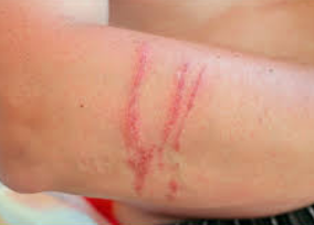 파상풍의 위험성