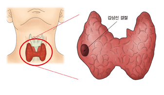 갑상선-혹