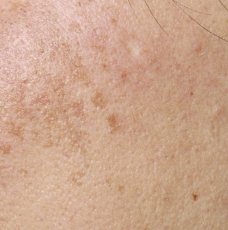 트라넥삼산(트리넥삼삼)과 먹는 기미약, 기미가 생기는 원리와 작용기전 비교 설명 사진