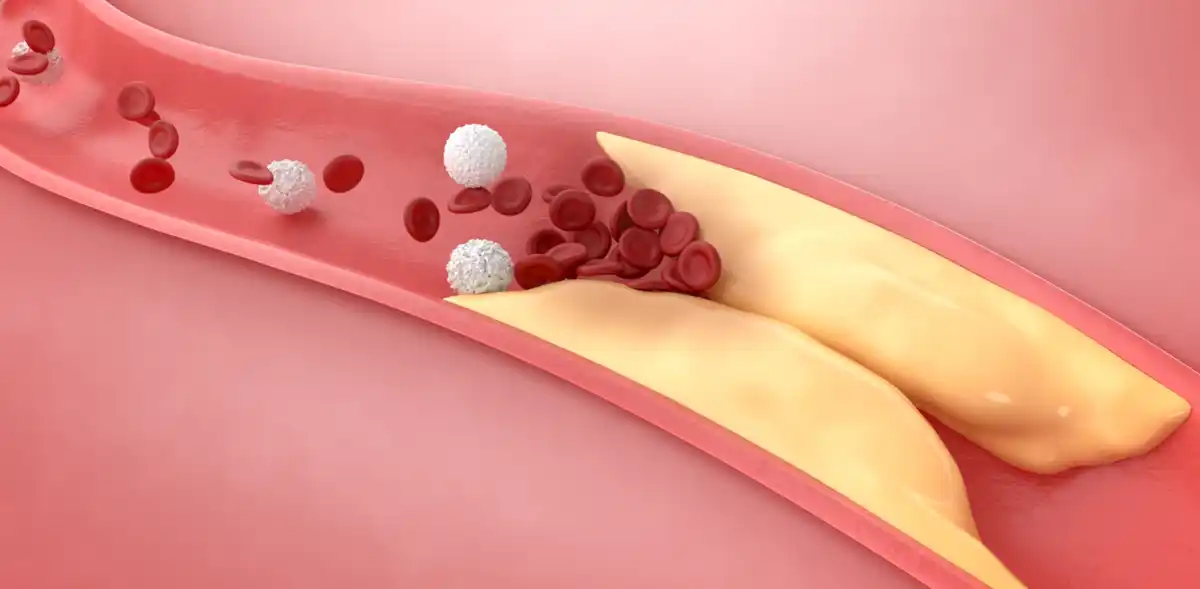 사람혈관-노란색지방-막힘-동맥-3D이미지