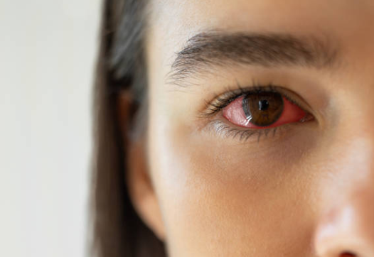 눈 충혈-원인-설명하는-사진
