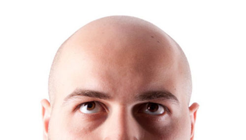 탈모인-남자