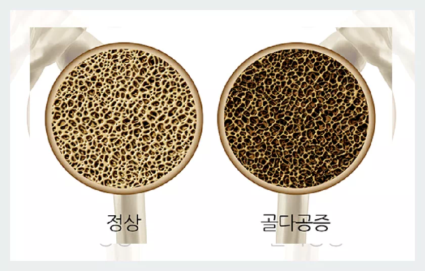 골다공증과 정상