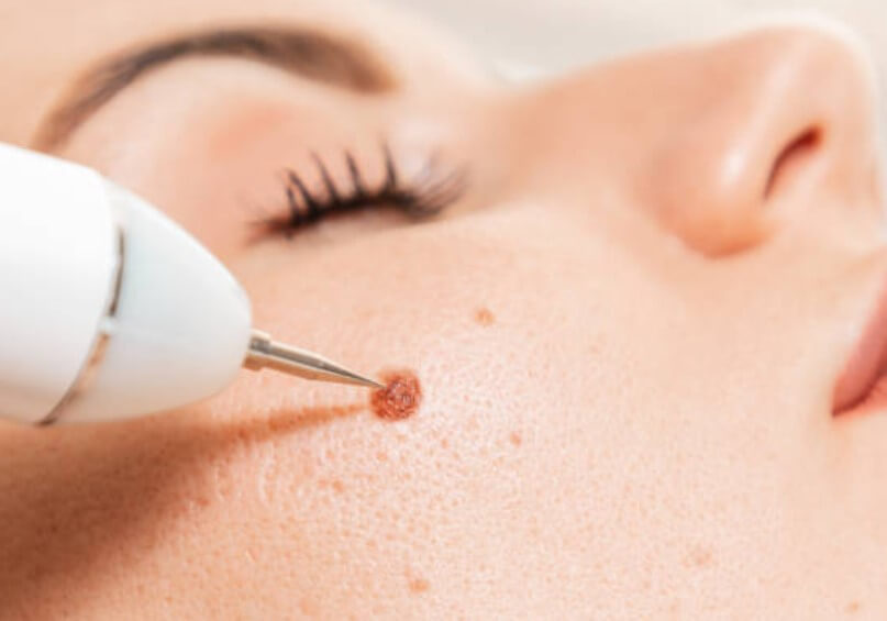 눈썹꼬리윗부분점