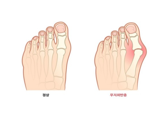 정상 발가락과 무지외반증