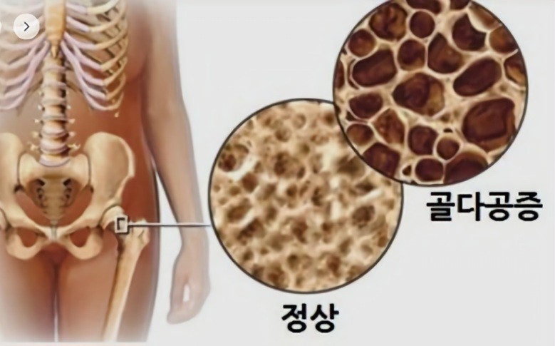 골다공증