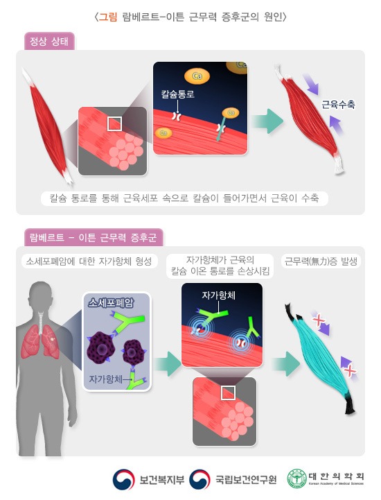 람베르트-이튼 증후군