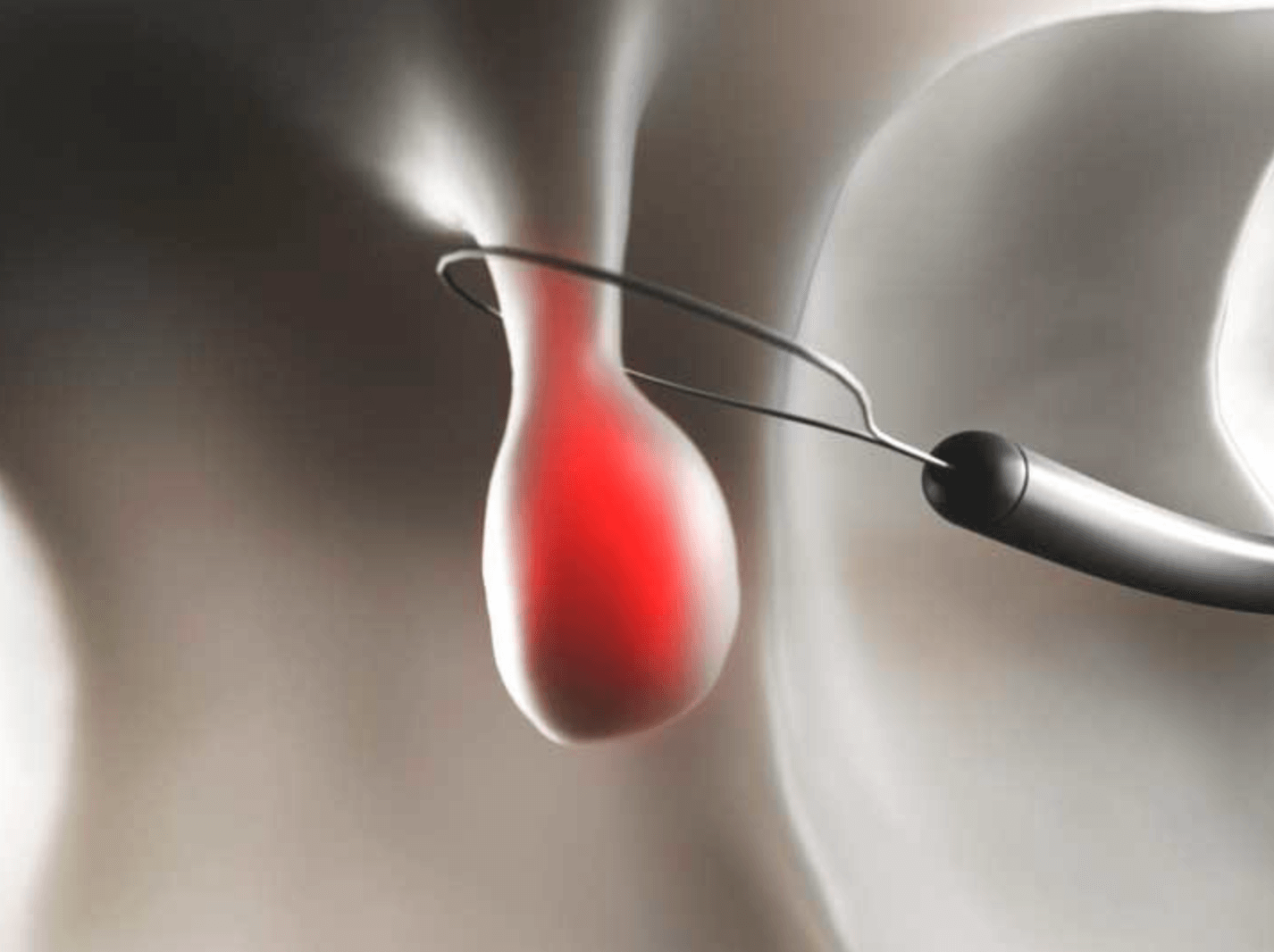 대장내시경-용종제거