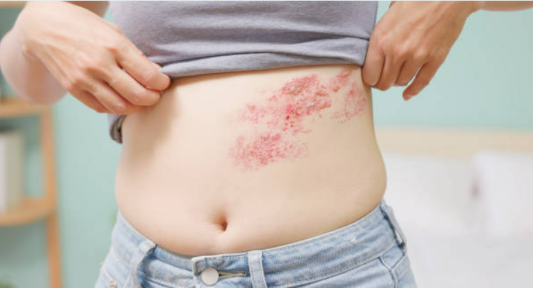 대상포진원인 자가진단