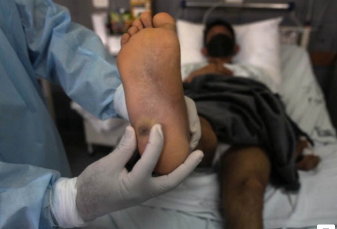 엠폭스 뜻 어떤 증상 및 원인 엠폭스 격리 및 예방접종