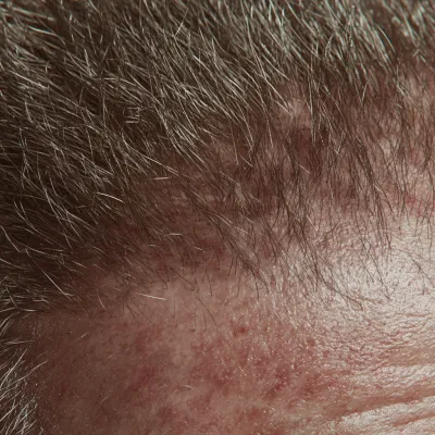 대상 포진 두피 증상 7가지, 초기 단계에서 확인하세요!_2