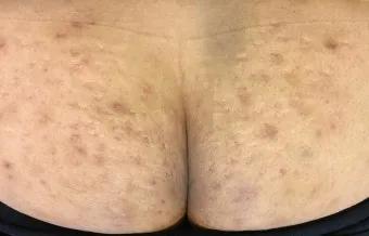 엉덩이 종기가 생기는 이유 왜 생기고 어떻게 관리할까요 완벽 가이드_7