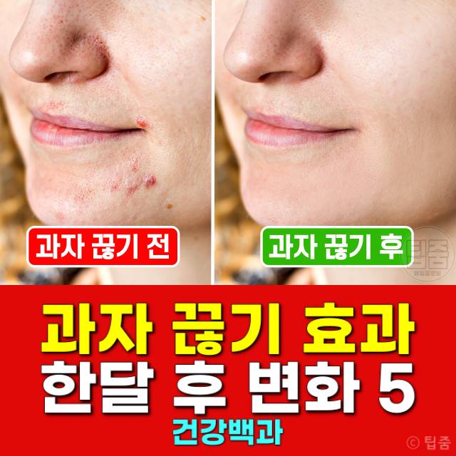 과자 끊기 효과 한달 후 피부 여드름