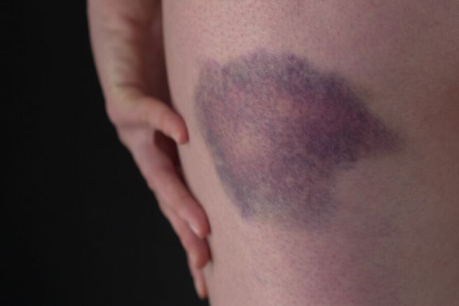 몸에 멍이 잘드는 이유