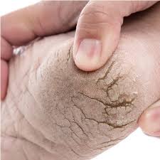 무좀의 주요 증상