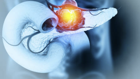 췌장암 초기증상 검사방법 생존율 알아보자!