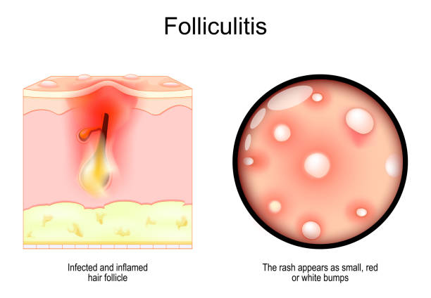 얼굴 모낭염이란