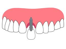 잇몸 염증 치료제 베스트 5