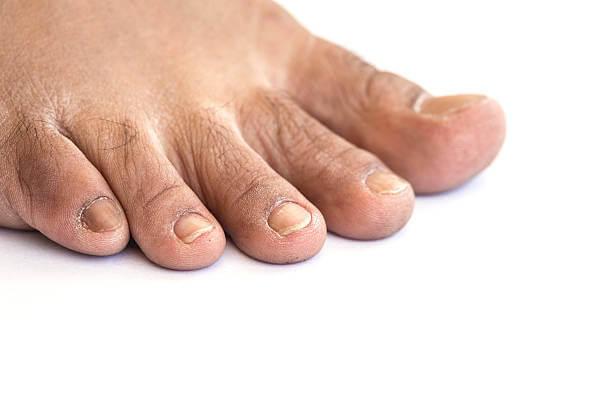 새끼발톱 갈라짐, 원인과 예방방법 때로는 작은 부위에 대한 관심 부족으로 인해 큰 문제가 발생할 수 있습니다. 이번 글에서는 새끼발톱이 갈라지는 이유와 예방 방법, 그리고 집에서 할 수 있는 치료 방법을 참고하시기 바랍니다. 이제부터 새끼발톱에 대한 지식을 쌓아 보세요.