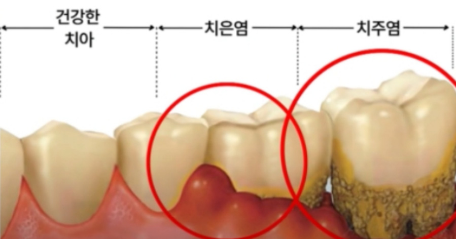 정상적인 치아와 치은염인 치아와 치주염인 치아를 비교하고 잇는 것을 찍은 그림 사진