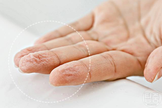 손가락 주름 병 질환 갑상선 탈수증 레이노 루푸스 림프부종 경피증