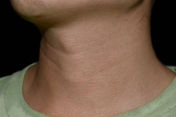 갑상선항진증의 원인과 증상