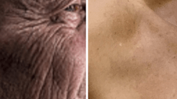 자외선 노출에 따른 피부 노화 차이