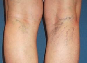 하지정맥류 증상