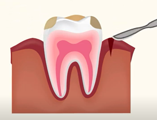 치주염의 원인 및 증상