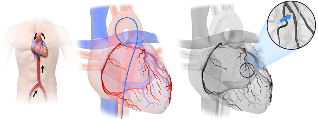 Percutaneous coronary intervention 경피적관상동맥중재술
