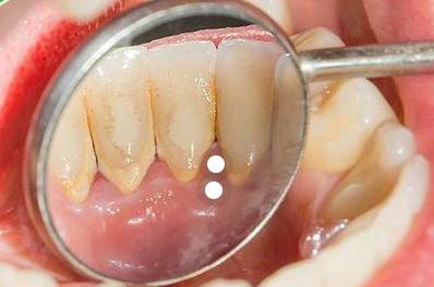 치석 모습 (사진 : Pinterest)