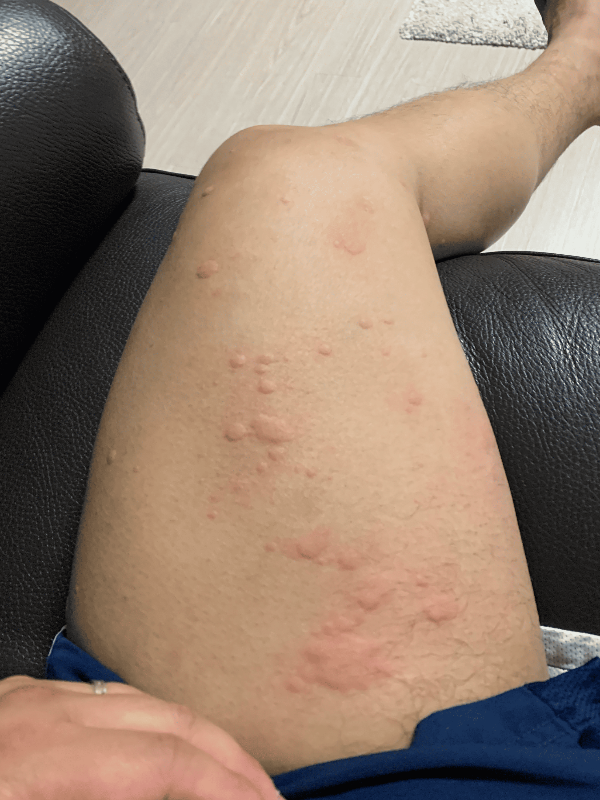 심한 두드러기증상