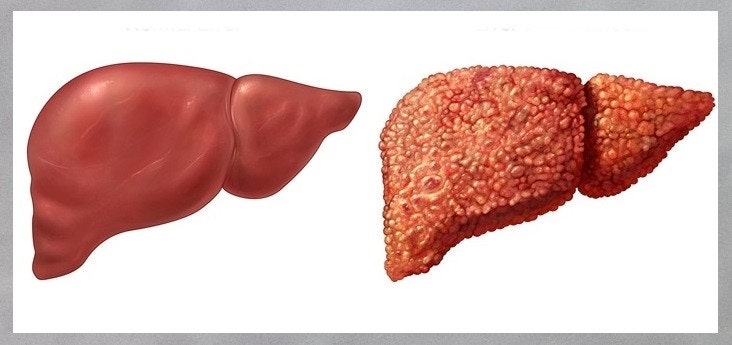 50대 이상 꼭 알아야 할 간경변 증상