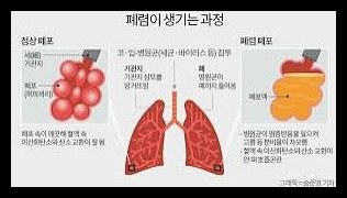 폐렴 예방접종 가격 시기