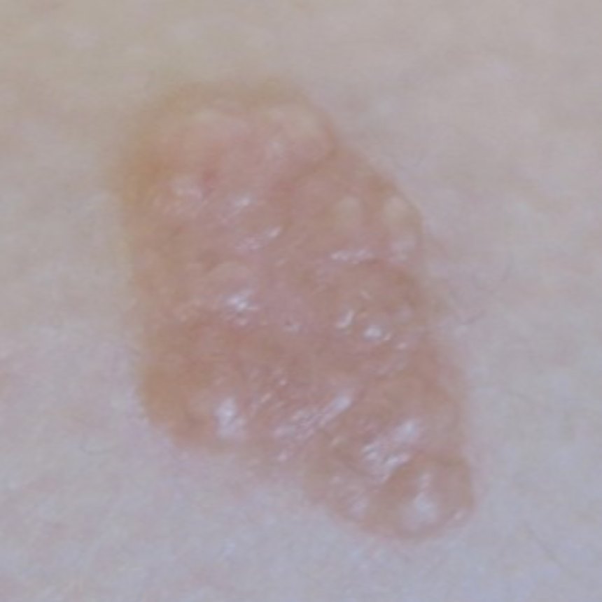 신경섬유종 초기 증상&amp;#44; 혹시 나도? 놓치면 안 되는 신호