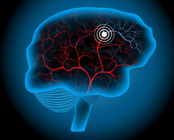 뇌경색 초기증상 10가지