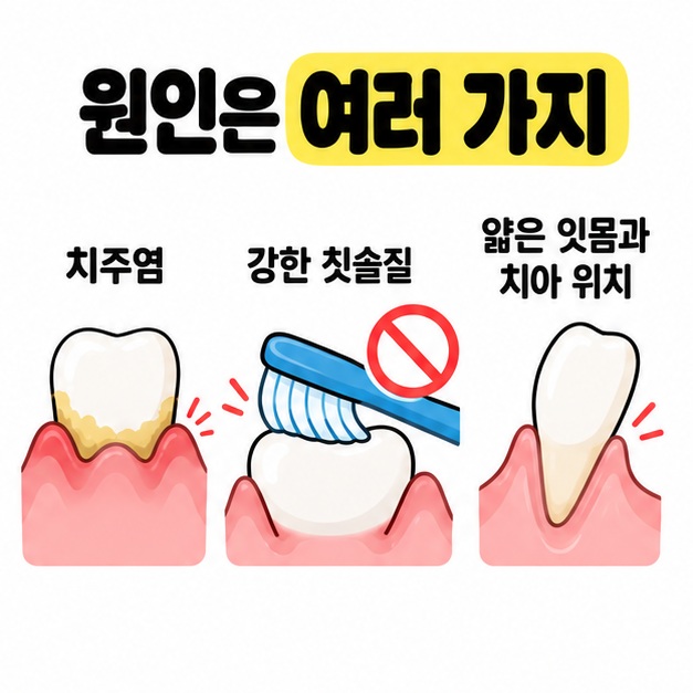 치주염, 강한 칫솔질, 얇은 잇몸과 치아 위치를 세 가지 치아 그림으로 나누어 보여 주는 잇몸 퇴축 원인 안내