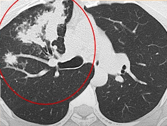 폐결핵 초기증상, 진단 치료 및 주의할점