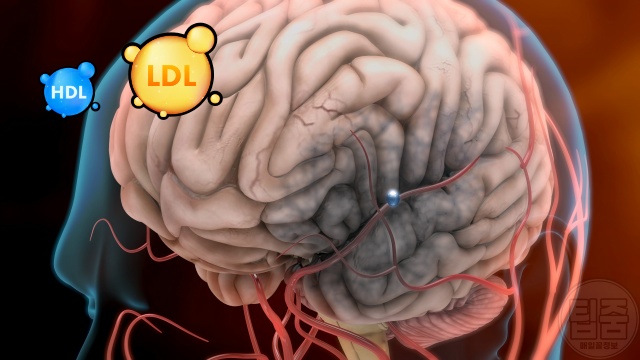뇌졸중 환자 공통점 콜레스테롤