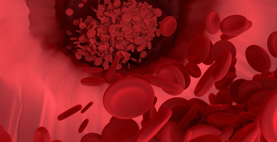 고지혈증에 나쁜 음식으로 혈관에 노폐물이 쌓인 모습