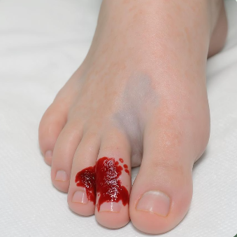 발톱이 검게 변하는 이유 7가지와 해결 방법 5