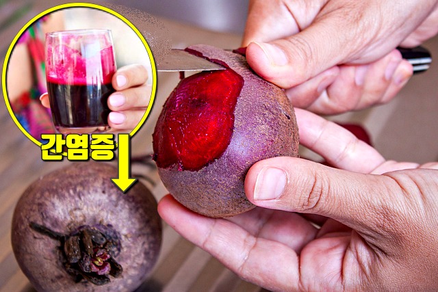 간에 좋은 음식,지방간에 좋은 음식,비트 효능,간암,간경화