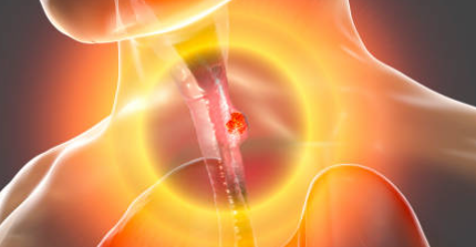 식도암 초기 증상 식도염 증상 식도염에 좋은 음식 식도염 치료법 식도염 가슴 통증