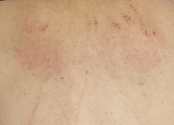 옻올랐을 때 증상부터 치료까지, 절대 하지 말아야 할 행동은?